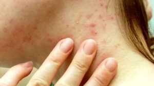 Vaiolo delle scimmie: iniziano le vaccinazioni in Piemonte