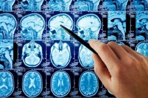 Salute del cervello, ad Alessandria quattro giorni tra prevenzione e informazione